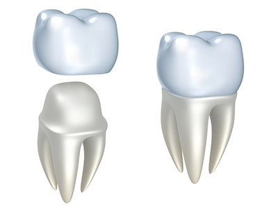 What Is The Dark Line On Crowned Tooth Next To The Gumline?