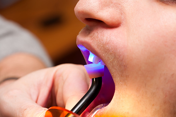 Dentist performing dental bonding treatment on patient