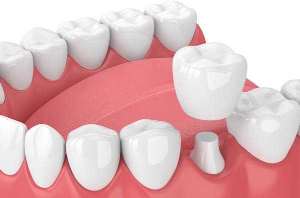 Rendering of jaw with dental crown from Upland CA