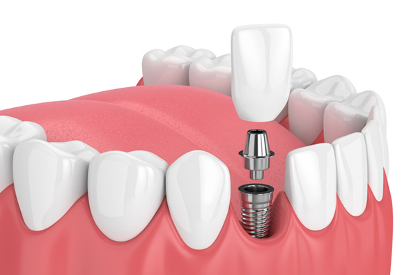Rendering of jaw with dental implant from Upland California Rendering of jaw with dental implant from Upland California