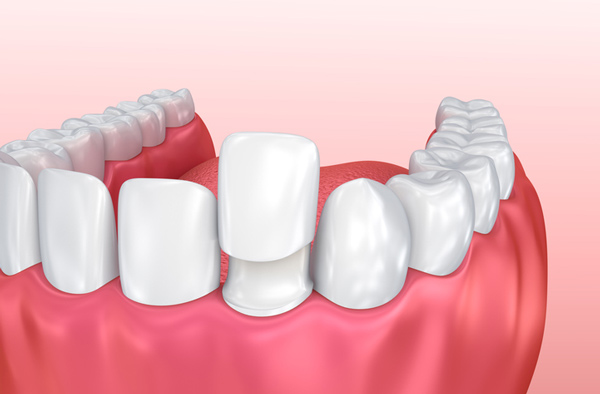 Rendering of jaw with porcelain veneer on tooth in Upland CA